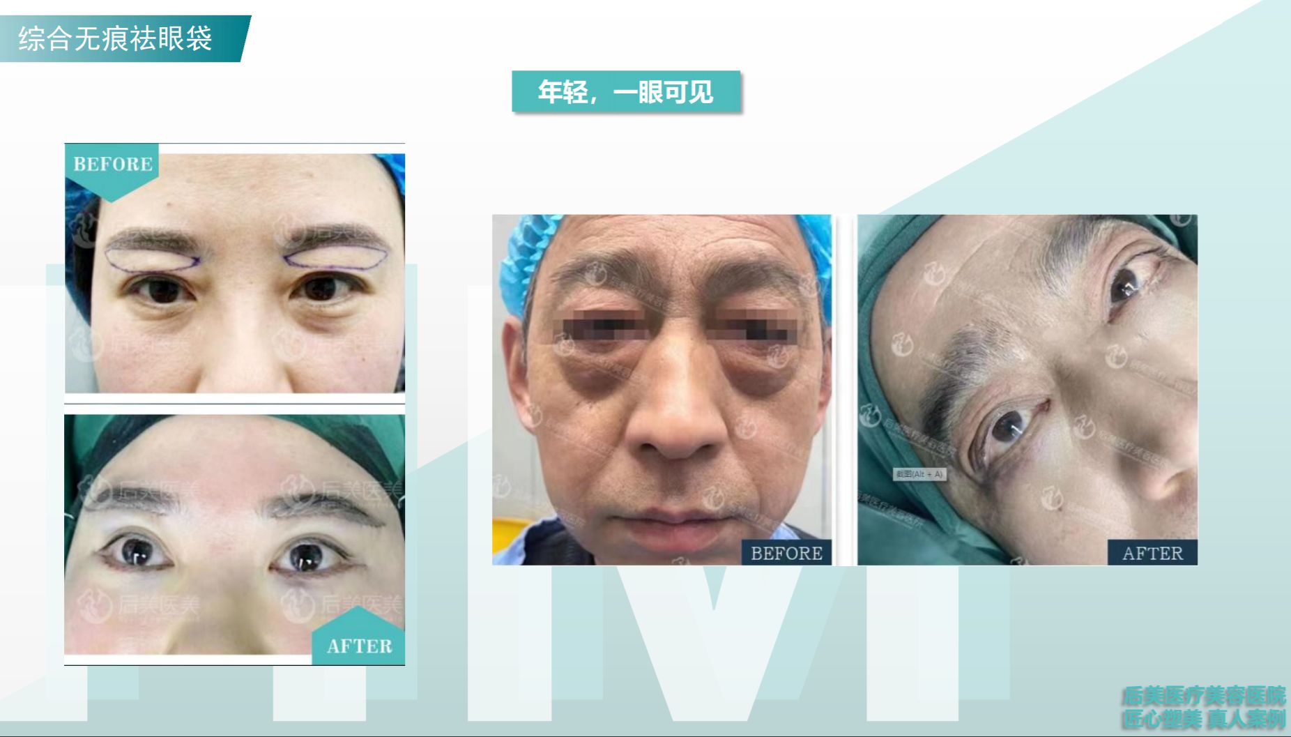 宜昌仁和医院激光去眼袋效果真实可靠吗？过来人分享亲测体验