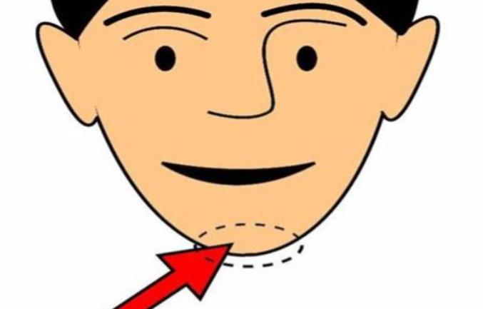 舒凯翊做假体下巴好不好?亲测效果自然!结合30例peek下巴病例分析