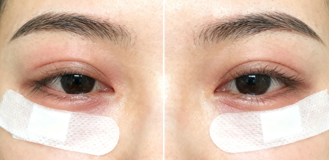 杭州千晴医疗美容价格贵吗?埋线双眼皮2800元起,收费挺实在