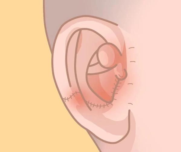 医生技术大PK:蒋海越的扩张法vs章庆国的肋软骨耳再造哪个更好?