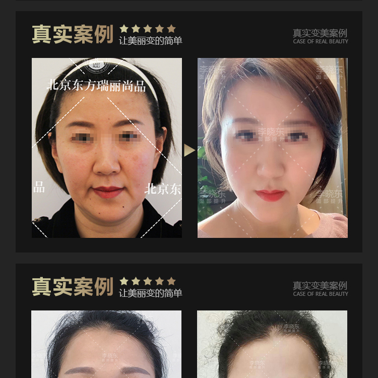 上海吕炜亮面部提升怎么样?闺蜜做了没踩坑,面部抗衰特色是脸不僵超自然