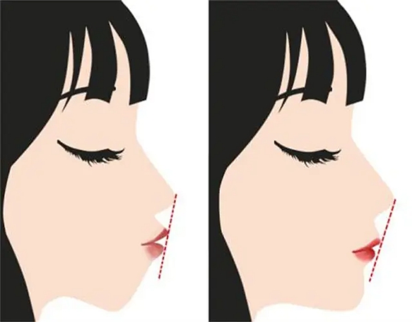 何锦泉面部不对称手术价格避坑要点