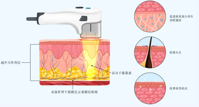 影响厦门黄金超声炮价格的几个关键因素