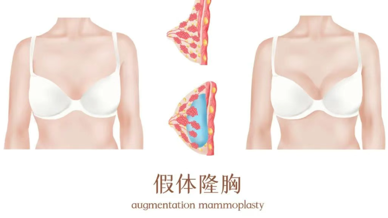 四、长沙雅美假体隆胸医生团队与技术优势