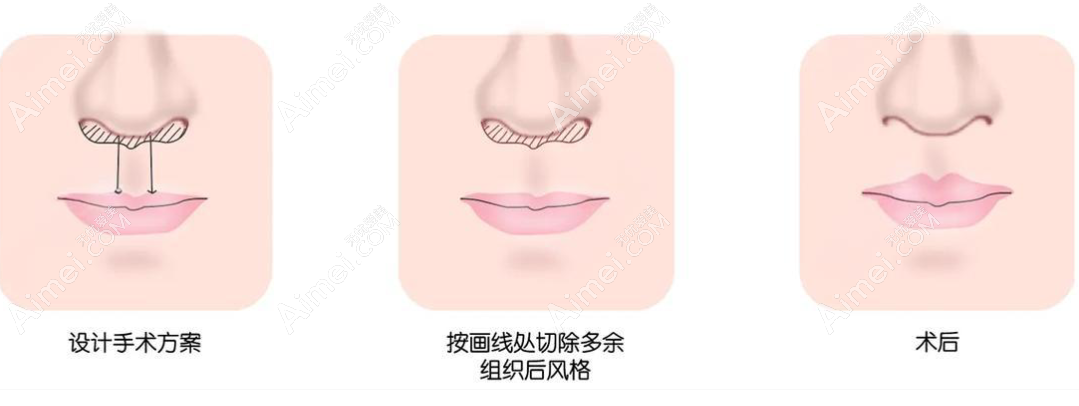 逐个解析上海人中缩短术好的医生