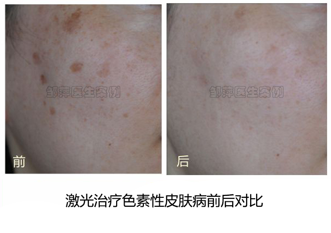 长沙雅美整形医院祛斑价格表2025更新！激光祛斑980元起，超皮秒限时5折抢购