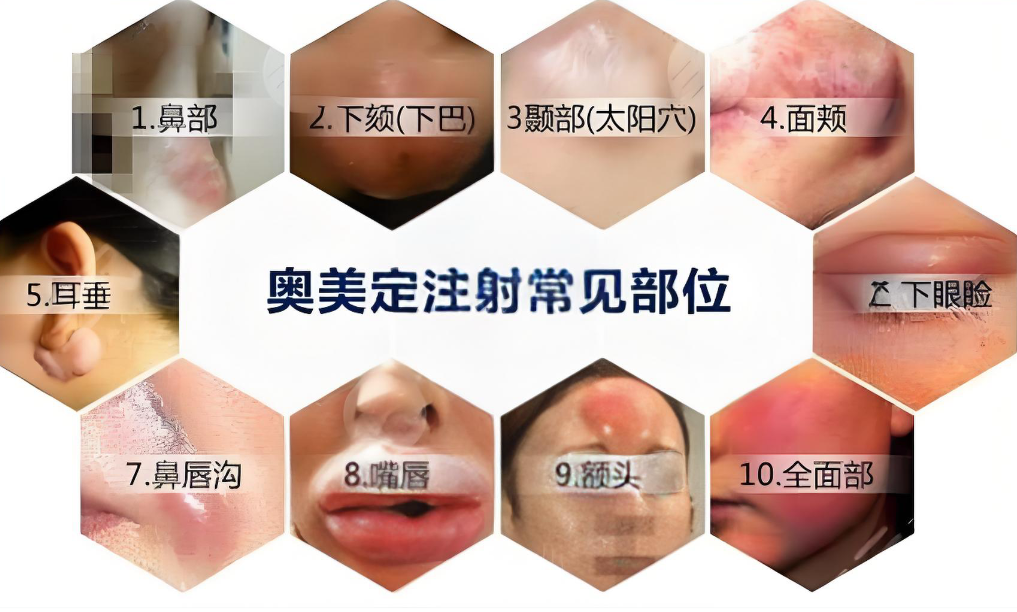 奥美定取出后脸塌别慌!6 个月后修复更安心,苹果肌 / 太阳穴塌选生物补片 2-4 万,刺激胶原全补回~