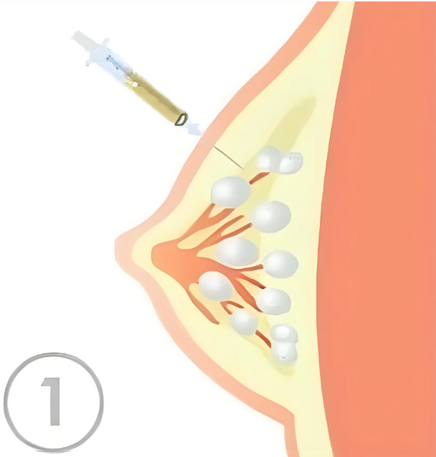 2025新!脂肪隆胸a到b需要多少钱?2-4万元搞定,腰腹/大腿取脂150-200ml ,单次填充超自然~