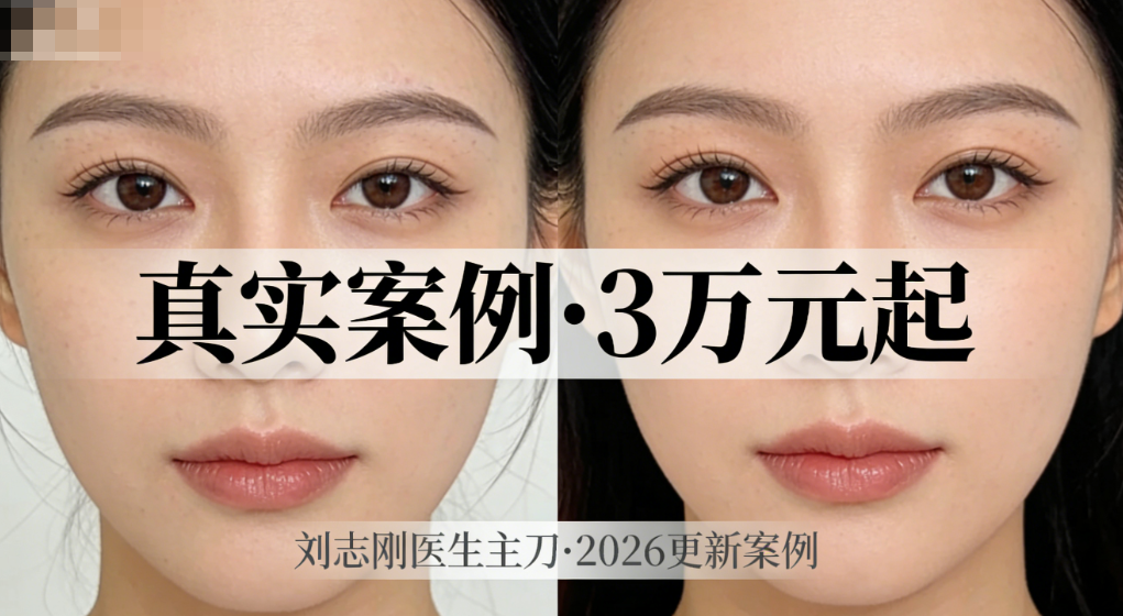 2026刘志刚外眼角修复技术好