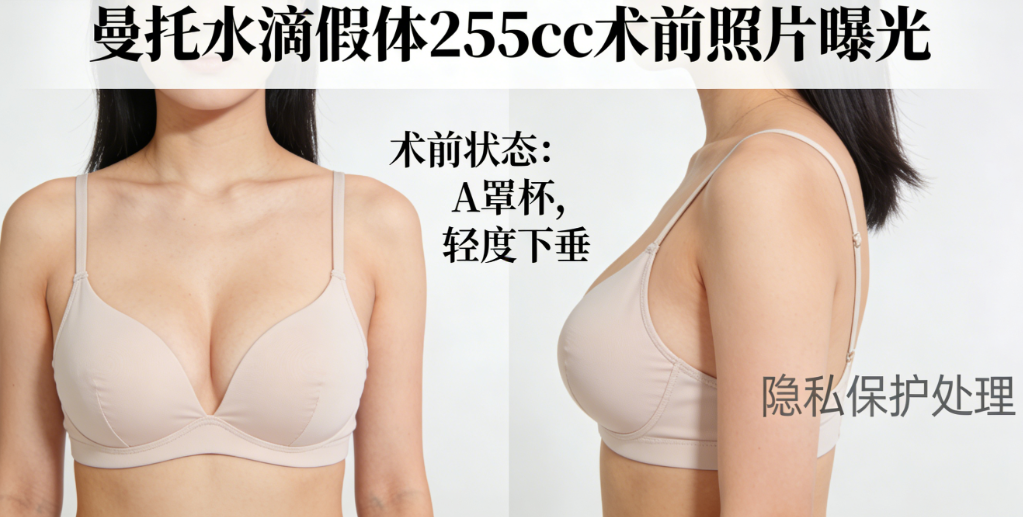 曼托水滴假體255cc前后照片對比