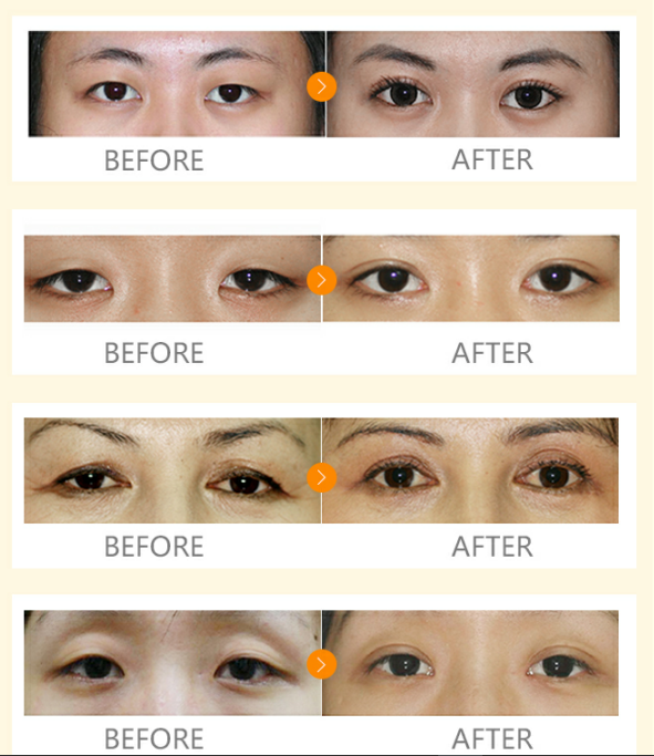 平顶山安一峰割双眼皮怎么样？2025年真实案例+价格对比，自然效果获百人推荐！