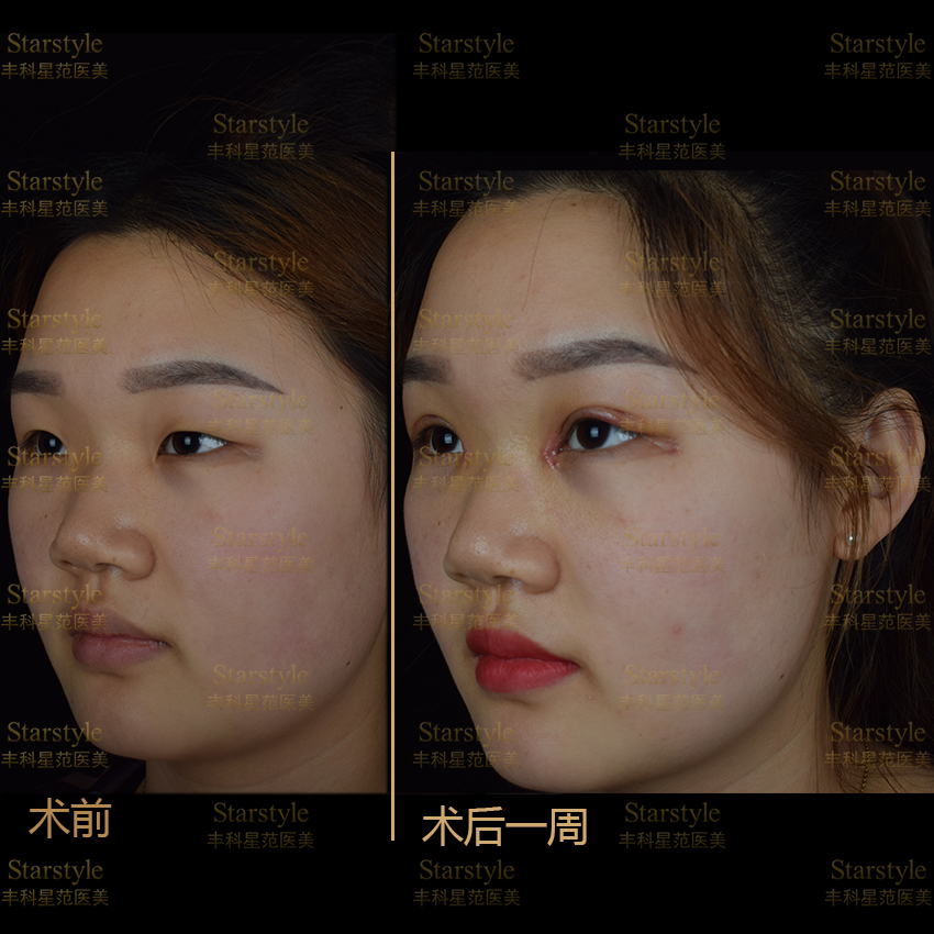 曹林双眼皮失败免费修复吗?NO,免费针对初眼全切或修复1年内肿胀不退or不对称享免费微调