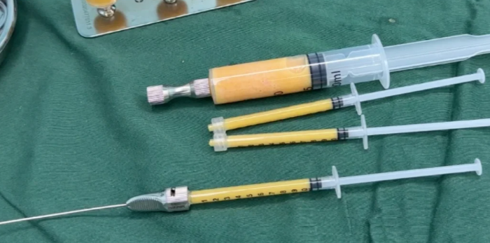 自体脂肪隆胸存活率常见疑问:孙泽芳医生的专门解答