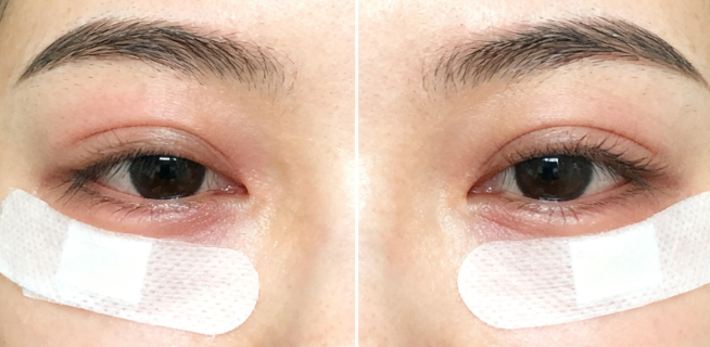 三、冷向峰做双眼皮价格的常见疑问解答