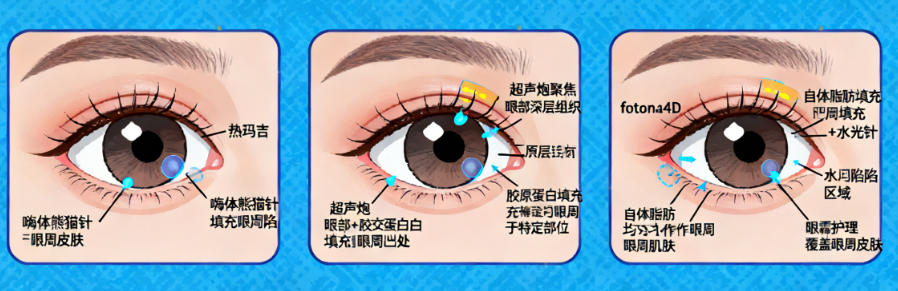 二、冷向峰做双眼皮不同手术方式的价格差异及核心特点