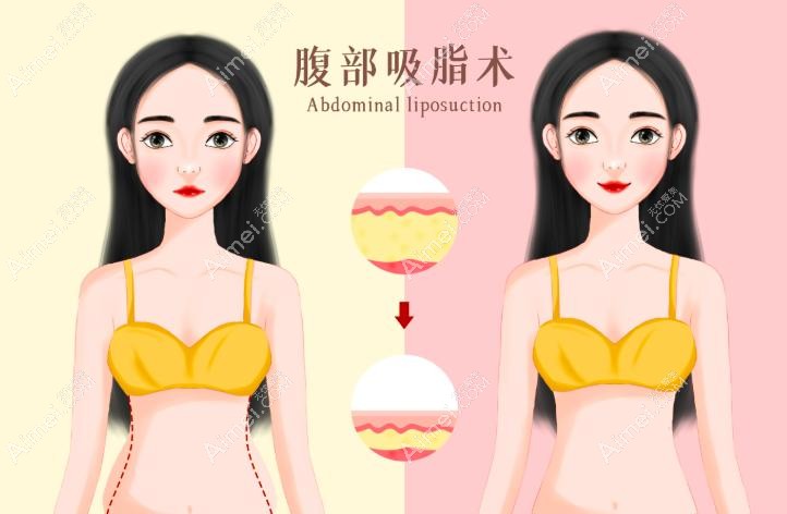 脂肪填充胡庆旭和王明利哪个更好?吸脂填充技术侧重点不同,王明利擅长……