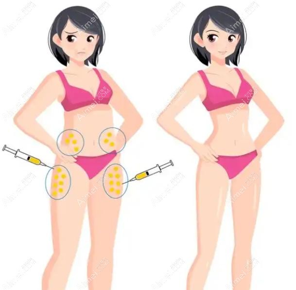 脂肪填充胡庆旭和王明利哪个更好 脂肪填充胡庆旭和王明利哪个更好