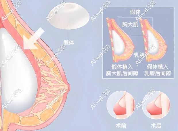 魔滴隆胸假体比傲诺拉软？过来人建议：魔滴假体软但傲诺拉更适合追求挺拔的