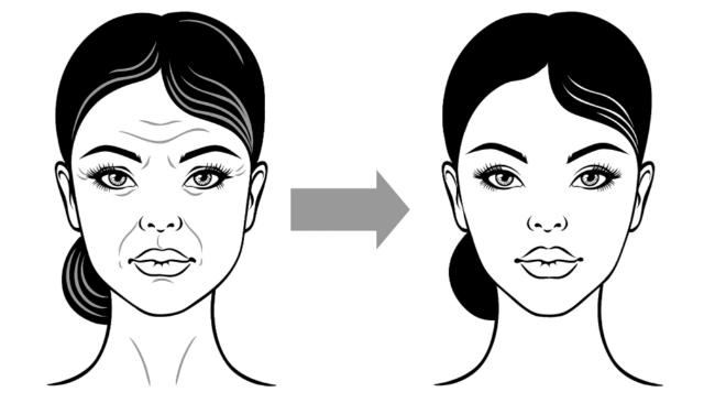 鄧業(yè)平三點脂肪平移術(shù)真人實例術(shù)后成效好