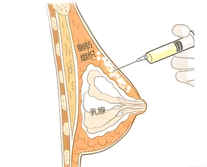 腰腹脂肪填充胸部优势