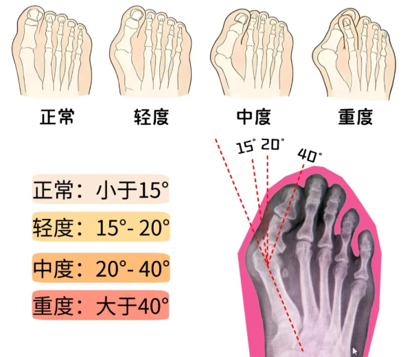 误区1:“微创就是小切口,所有医生都能做”