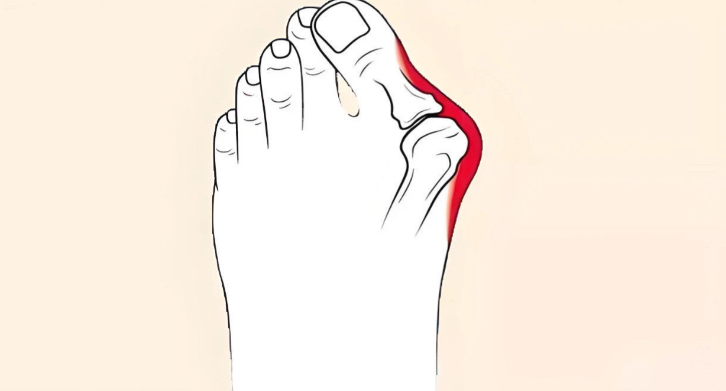 北京温建民技术和哪里的一样?档次和圣嘉新苏敬达同属北京第一梯队拇外翻医生,温氏微创矫正更稳