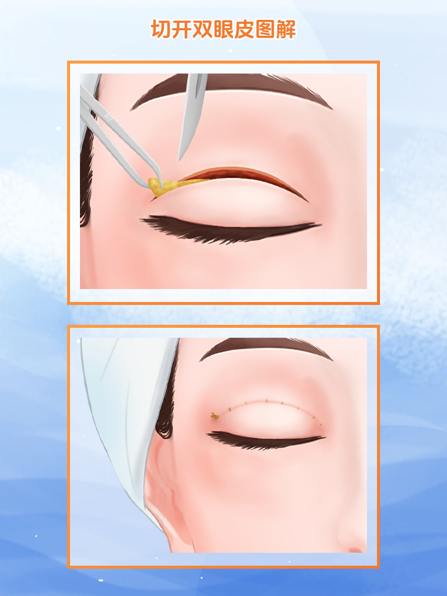 上海伊莱美顾新安医生简介:15年临床经验,双眼皮口碑超稳