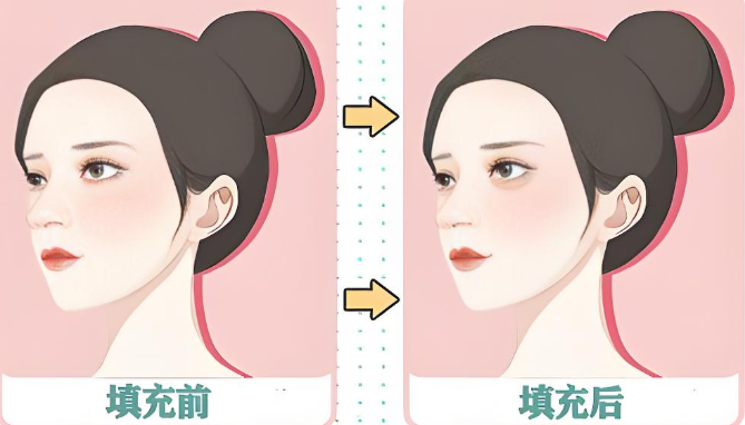 杜园园修复下眼睑退缩案例