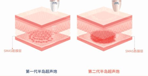 超声炮基础版和加强版的疗效对比及维持周期www.aimei.com