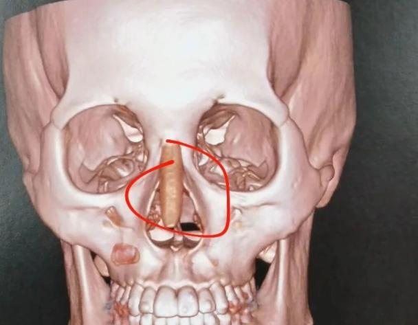 珠海鼻修复哪家医院好？5家私立机构真实测评，鼻综合和驼峰鼻矫正就选这家靠谱！