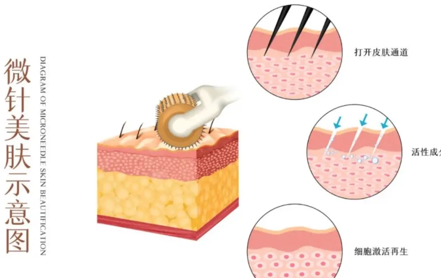 怕假货?南京艺星美迪迈黄金微针有资质+扫码验真,闭眼冲