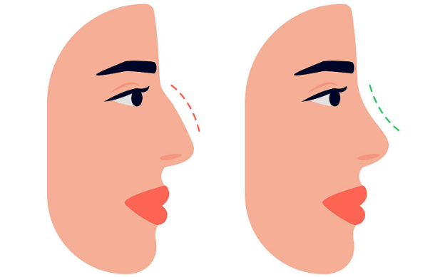 长沙隆鼻医生刘凯简介