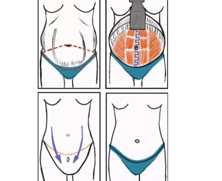 成都李修膚華塑醫(yī)療美容診所腹壁成形做得好