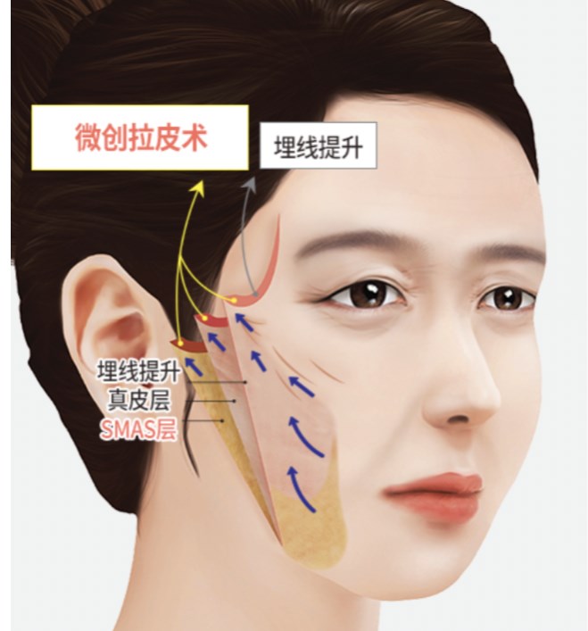 亲测秦宏智拉皮3个月：真实疗效到底怎么样www.aimei.com