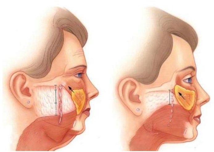 選擇高亞東醫(yī)生做拉皮的注意事項www.cnxhy.cn