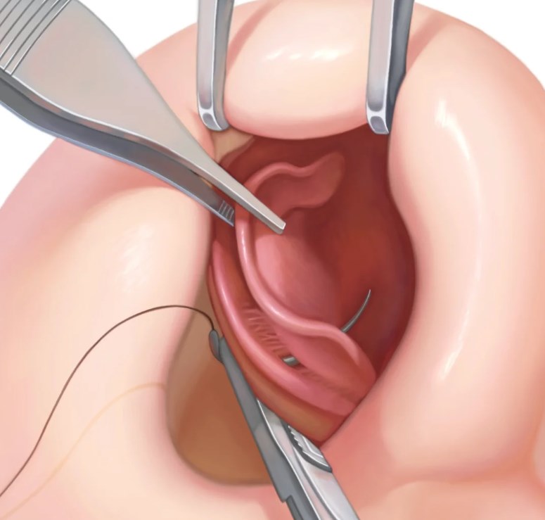 四、選擇鼻整形醫(yī)生的5個關鍵要素