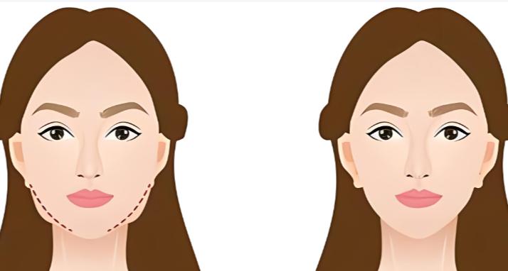 汽化面吸與傳統(tǒng)面吸的3點核心差異