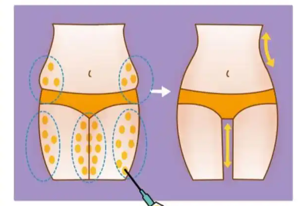 杭州李增輝醫(yī)生個(gè)人資料簡介：脂肪填充找他技術(shù)穩(wěn)，坐診明州醫(yī)院