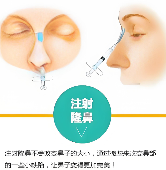 五、鼻整形手术常见问题与刘超峰医生的专门建议