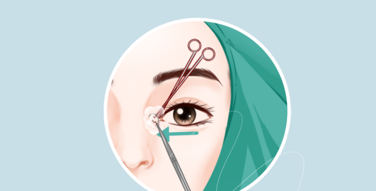 北京萊美安王恒修復(fù)內(nèi)眼角價(jià)格：9800-16800元起透明收費(fèi)，眼綜合修復(fù)19800元起