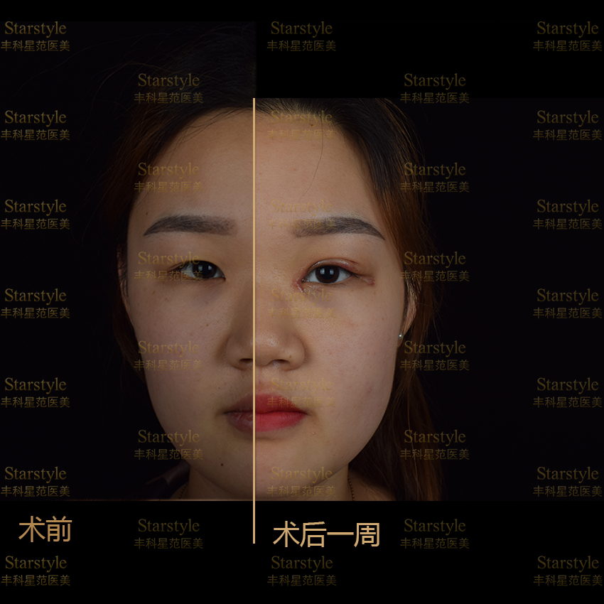 重庆刘波双眼皮案例真实分享:术后效果自然还是夸张?亲测反馈来了!