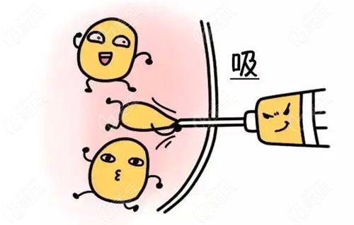 李增辉医生抽脂价格表