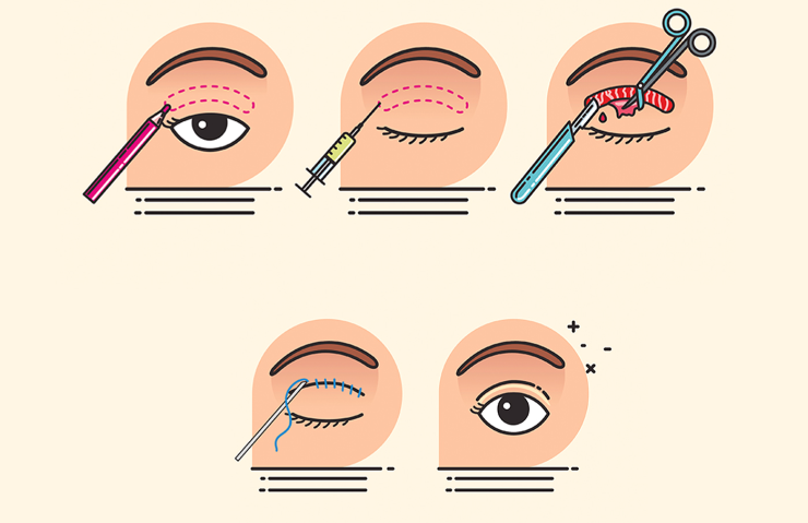 罗飞彪医生眼综合术后3个月真实疗效反馈:自然度与稳定性解析