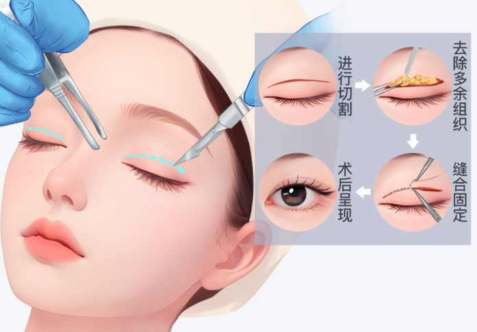 五、双眼皮手术常见问题与何星医生的专门建议www.aimei.com