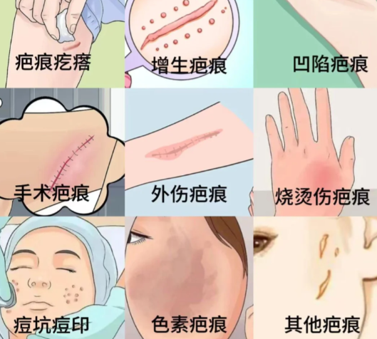 3. 昭通美立方医疗美容门诊部：黄金微针 + 激光联合，痘坑患者的“救星”