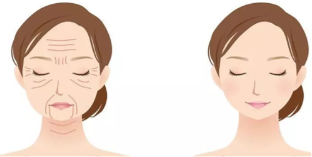 三、黄金热拉提VS热玛吉：技术差异与性价比分析