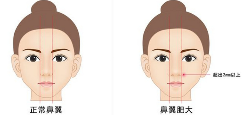 上海王琳医生做鼻翼缘手术好吗？2026新版案例分享，术后3个月效果不错