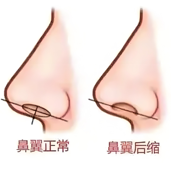 二、上海王琳醫(yī)生鼻翼緣缺損修復(fù)的常見方法及技術(shù)特點(diǎn)