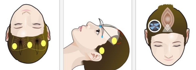 三、杨大平小切口拉皮除皱实例就诊全攻略