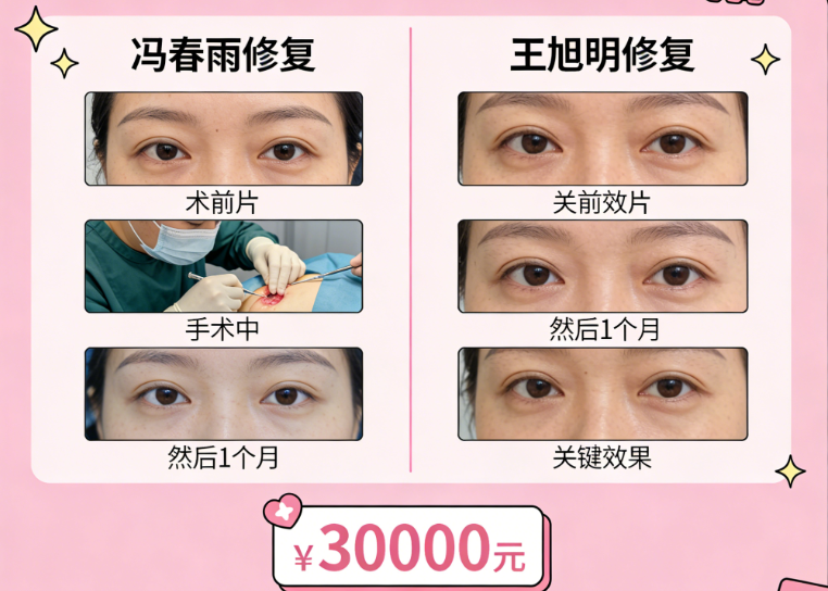 成美整形冯春雨和王旭明做鼻修复